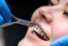 6 Damon Braces Factors to Consider Before Treatment