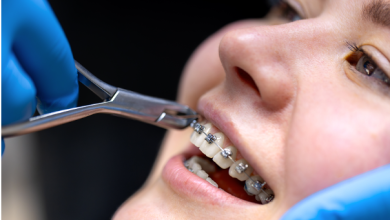 6 Damon Braces Factors to Consider Before Treatment