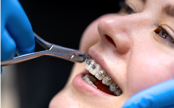 6 Damon Braces Factors to Consider Before Treatment 6 Damon Braces Factors to Consider Before Treatment
